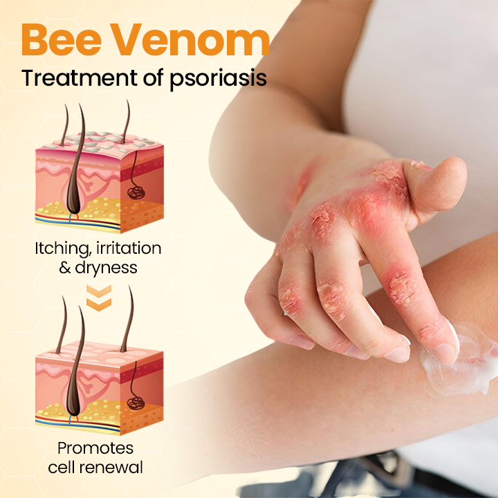 [✅Official Authorized Store] Medazy® BeeLieve Psoriasis Skin Care