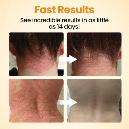 [✅Official Authorized Store] Medazy® BeeLieve Psoriasis Skin Care